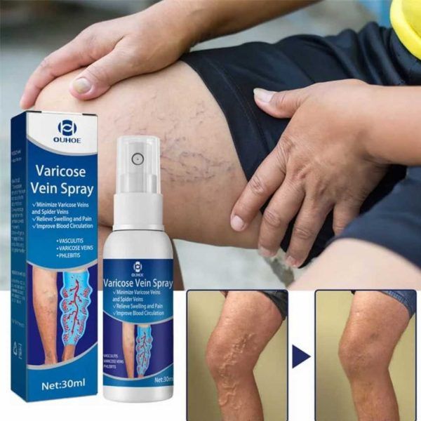 Varicose Vein Treatment Spray | ট্রিটমেন্ট স্প্রে