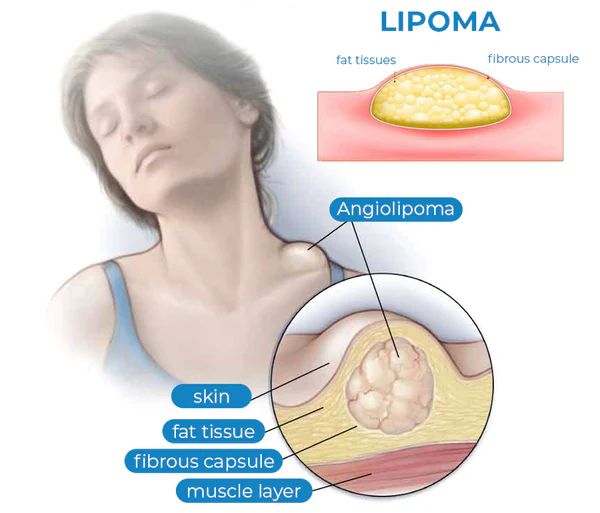 3pcs Lipoma Treatment Cream (3pcs) | ট্রিটমেন্ট ক্রিম পিস Specification 2