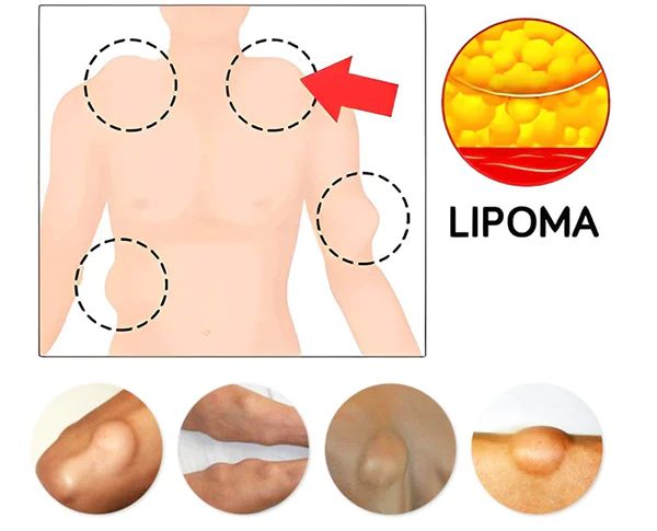 3pcs Lipoma Treatment Cream (3pcs) | ট্রিটমেন্ট ক্রিম পিস Specification 3